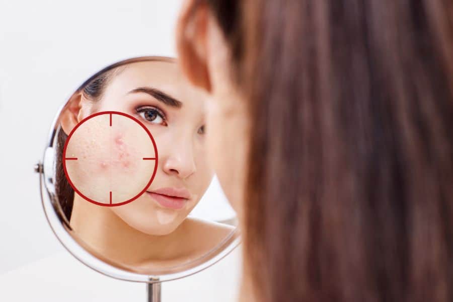acne caused by digestive problems