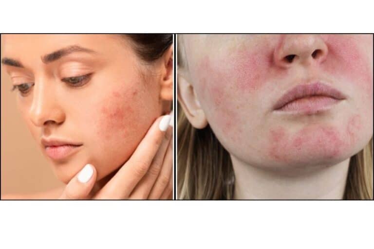 acne vs rosacea