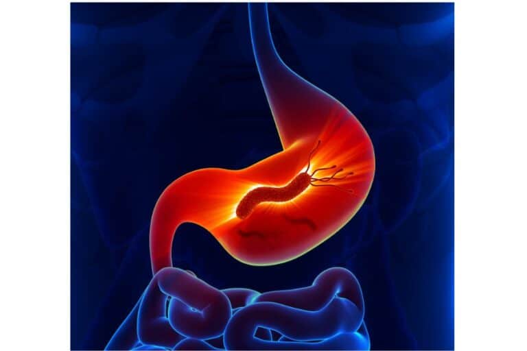 natural remedies for H. pylori infection