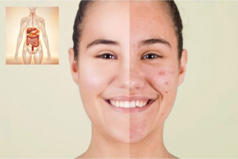 how to get rid of acne caused by digestive problems