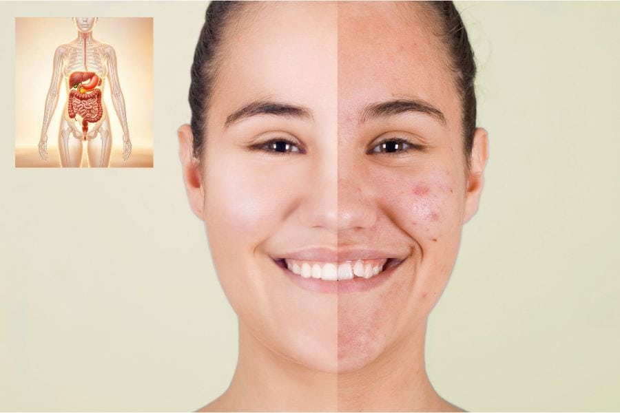 how to get rid of acne caused by digestive problems how to get rid of acne caused by digestive problems